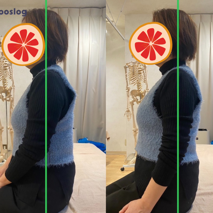 反り腰による慢性腰痛の改善事例