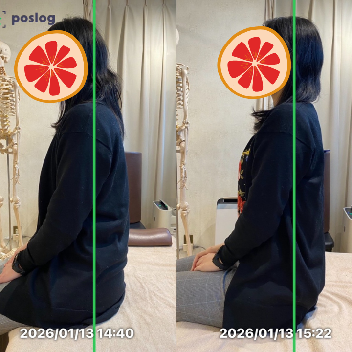 巻き肩とO脚が顔のたるみに関係していた事例