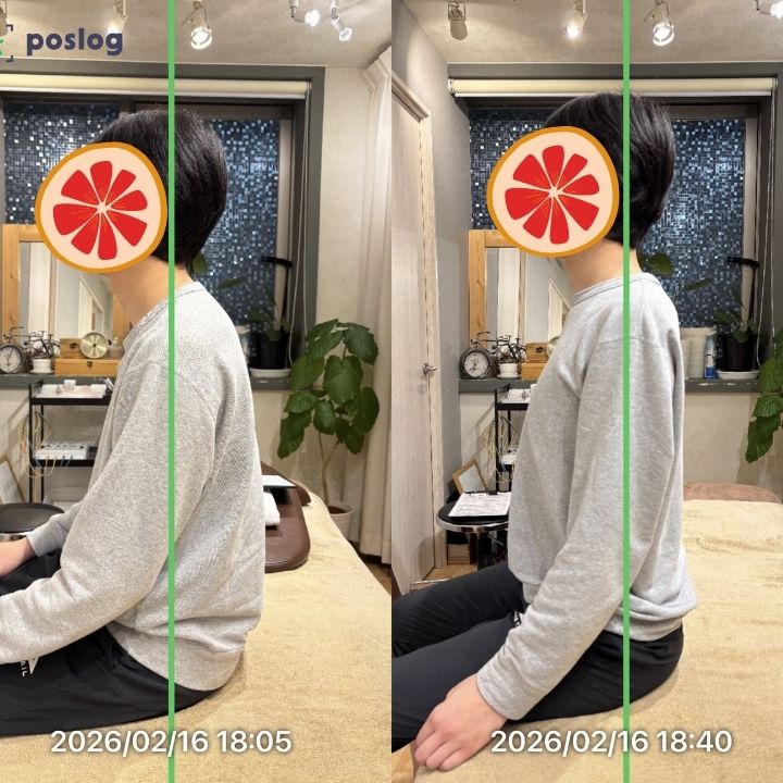 猫背とストレートネックを改善したい20代男性の事例
