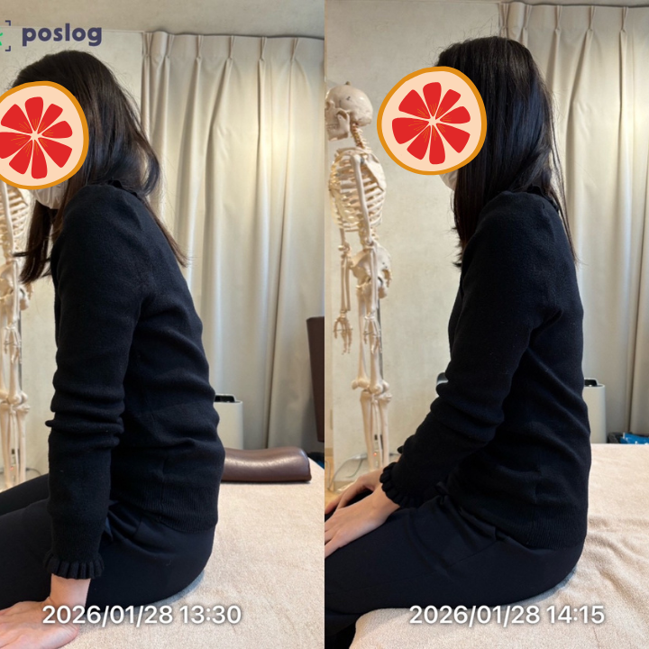腰痛を繰り返していた40代女性の事例