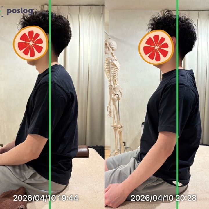 巻き肩・O脚・食いしばりが同時に起きていた事例