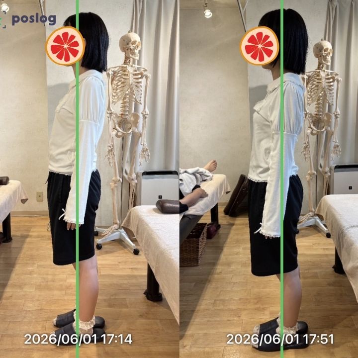 柔軟性はあるのに姿勢とO脚が進行していた事例