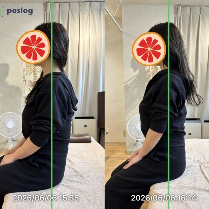 反り腰ではないのに太ももが太く見えていた事例