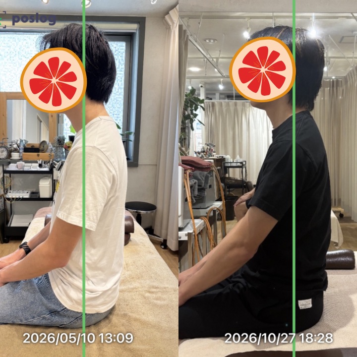 【男性の美容整体】ストレートネック・巻き肩・猫背の姿勢矯正｜半年間で約7割の改善を実感した症例の症例写真